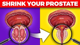 How to Shrink Your Prostate Naturally The 1 Nutrient You Need [upl. by Nolyarg371]