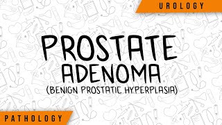 What To Do In Front Of A Prostate Adenoma  Urology  Clinical Signs Diagnosis Treatments [upl. by Joana7]