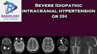 Severe Idiopathic intracranial hypertension or IIH [upl. by Mick]