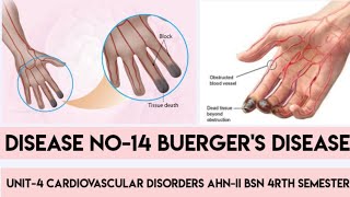 Buergers DiseaseDisease No14Unit4 Cardiovascular DisordersAHNIIBSN 4rth semesterIn Urdu [upl. by Teferi]