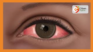 Mombasa County issues public health alert over spread of red eye disease Conjunctivitis [upl. by Colombi]