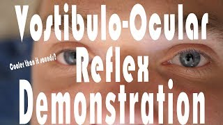 Caloric Testing COWS VestibuloOcular Reflex Hack  It Works [upl. by Atilamrac]