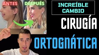 CAMBIÓ su CARA por completo  CIRUGÍA ORTOGNÁTICA [upl. by Anitsud226]