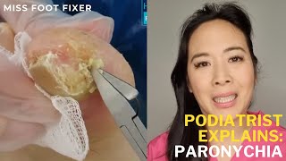 Emergency Nail Infection Treatment Quick Paronychia Relief While Traveling  Miss Foot Fixer [upl. by Reisman]