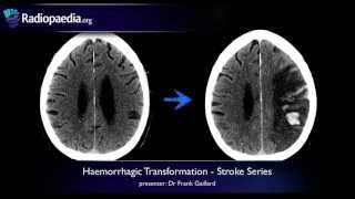 Stroke Haemorrhagic transformation  radiology video tutorial CT MRI [upl. by Anuahsat]