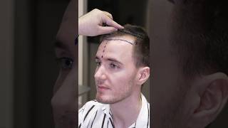 Cosmedica Clinic Hair Transplant in Turkey shorts hairtransplant video [upl. by Adnolohs]