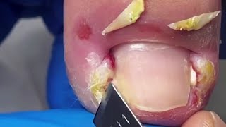 The Most Shocking Ingrown Toenail Removal 【Yinuo Pedicure】 [upl. by Ltney]