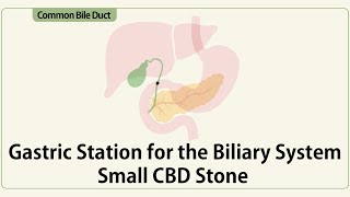 Gastric Station for the Biliary System Small CBD Stone Missed by ERCP [upl. by Yelrebmik]