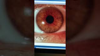 Severe contact lensrelated infectious keratitis scar Kanellopoulos MD [upl. by Yeknarf]