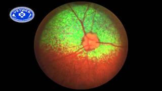 SARDS Sudden Acquired Retinal Degeneration Syndrome [upl. by Marti63]