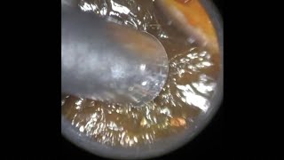 16  Acute Otitis Media with Effusion revealed post Ear Wax Removal with WAXscope®️ [upl. by Millisent]