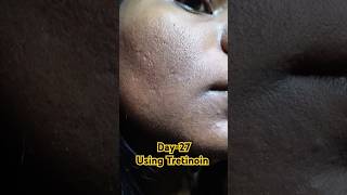 Day27 Using Tretinoin 0025 cream viralvideo tretinoin tretinoincream shorts youtubeshorts [upl. by Silevi]