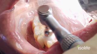 Dental Restoration with Isolite [upl. by Coleen]