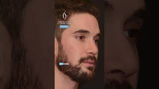 Nose and Chin Refinement by Dr Faisal Quereshy chinreduction nosesurgery cosmeticsurgeon [upl. by Wally68]