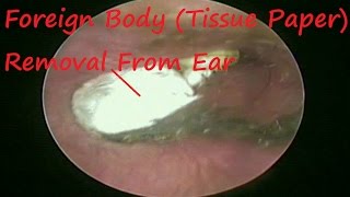 Suffering From Ear Blockage Since 6 Months Itching with Tissue Paper  Got Relief After Procedure [upl. by Suidualc]