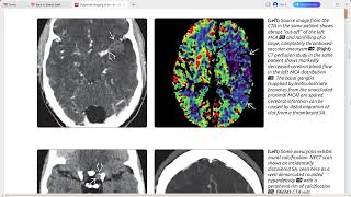 SUBARACHNOID HEMORRHAGE BRAIN DIAGNOSTIC IMAGING SERIES [upl. by Ambrosine]