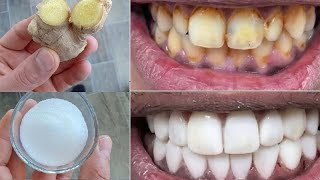 Can you whiten teeth at home in 2 minutes😁✨ Secret that Dentists dont want you to know [upl. by Oettam]