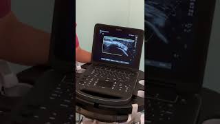 UltrasoundGuided Barbotage for Calcific Tendonitis  Kent MSK Clinic [upl. by Goodden837]