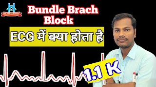 ecg मे rbbb क्या होता है  bundle branch block  ecg in hindi  lecture 16  RBB block  ecg [upl. by Ilocin]