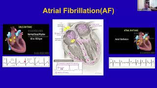 Atrial Fibrillation Most Common Arrhythmia Seen in Clinical Practice wDrs MasterampSchulman21424 [upl. by Shatzer]