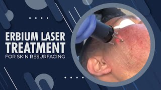 CO2 Resurfacing Laser Recovery [upl. by Rojam774]