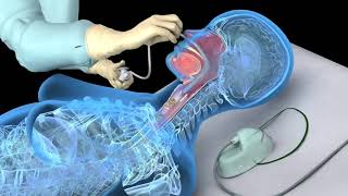 Nasotracheal suctioning NTS  3D animation [upl. by Dej]