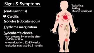 Acute Rheumatic Fever by E Rusingiza  OPENPediatrics [upl. by Tterrab791]