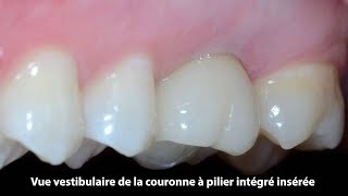 Placement direct et restauration d’une première molaire maxillaire avec une couronne [upl. by Zabrine157]