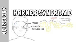 Horner Syndrome  anatomy causes pathophysiology investigation [upl. by Lynna506]