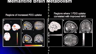 Treatment of Dementia [upl. by Seeto]