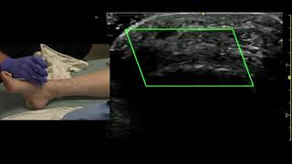 Ultrasound of the Dorsalis Pedis Artery [upl. by Baun]