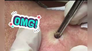 Ultimate Ear Blackheads Extraction Watch the Magic Happen [upl. by Cozza364]