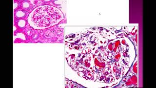 Thrombotic Microangiopathy part 1DrNoha Gamal [upl. by Lhok]