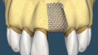 Implantes Dentários  Com Enxerto Ósseo [upl. by Assitruc]