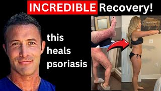 🔴1 Psoriasis Treatment  Jen Geissert [upl. by Alletnahs916]