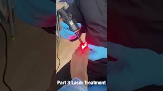 Lunula Laser targets nail fungus [upl. by Rabbi]