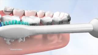 Tips on how use a Philips Sonicare toothbrush with braces Hygiene is a key part of daily care [upl. by Alejo300]