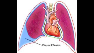 Pleural Effusions  Transudate Exudate amp Lymphatic [upl. by Doble]