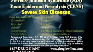 Dilantin Lawsuit SJS Side Effects with Dilantin [upl. by Rolecnahc]