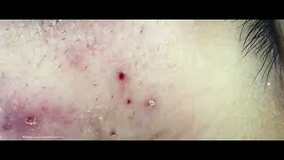 Big Cystic Acne Blackheads Extraction Blackheads amp Milia Whiteheads Removal Pimple Popping [upl. by Knowling]