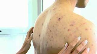 Acne NYC  212 6449494 NYC Cystic Acne Back  Pimples NYC  Acne Face NYC [upl. by Dyke997]