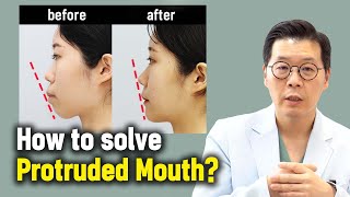 ENJP How to solve Protruded Mouth l Korean Protruded Mouth surgery case review [upl. by Amalie55]