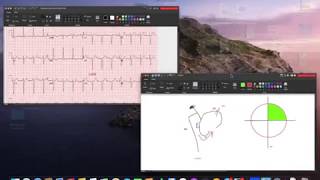 Left Anterior Fascicular Block LAFB  Left Anterior Hemiblock ECG [upl. by Iznyl]