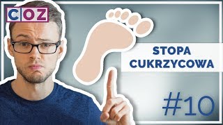 Zespół STOPY cukrzycowej 10 [upl. by Monroe453]