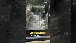 uterus Ultrasound phonk remix pelvic pelvis ultrasound ytviral ytshort abdomen medical yt [upl. by Ativak32]