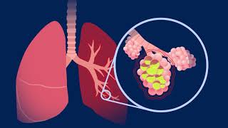 Understanding Pneumococcal Pneumonia [upl. by Eikciv376]