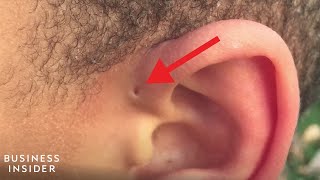 Explaining A Preauricular Sinus A Tiny Hole Above Some Peoples Ears [upl. by Moor]