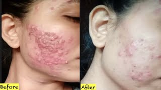 Acne treatment at home 3 days Acne Removal Challenge [upl. by Dulcia753]