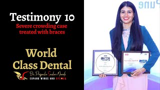 Premolar extraction along with ceramic braces  Dr Priyanka  World Class Dental [upl. by Bikales490]