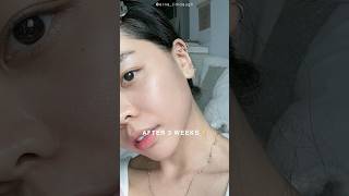 KOREAN SKINCARE CLINIC SAVED MY SKIN✨  Erna Limdaugh [upl. by Edythe]